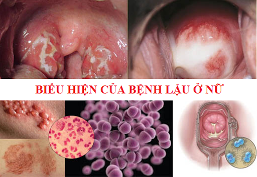 bệnh-lậu-ở-nữ-giới.png