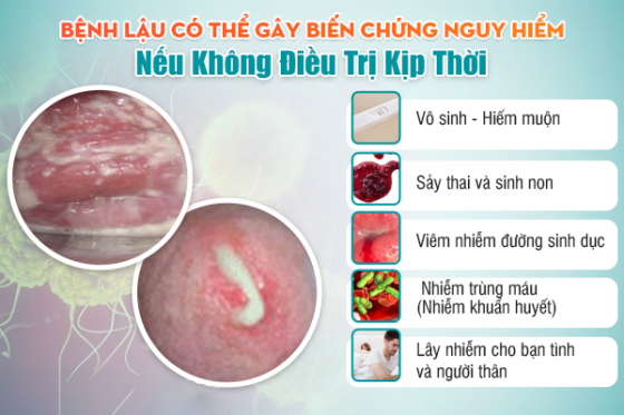 Bệnh Lậu Có Thể Gây Biến Chứng Nguy Hiểm Nếu Không Điều Trị Kịp Thời.png