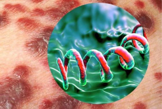 1761296574664176.jpg 3715eb29-tac-hai-cua-benh-giang-mai-doi-voi-nguoi-benh.jpg