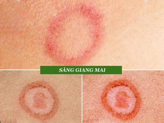 ảnh giang mai-2.jpg